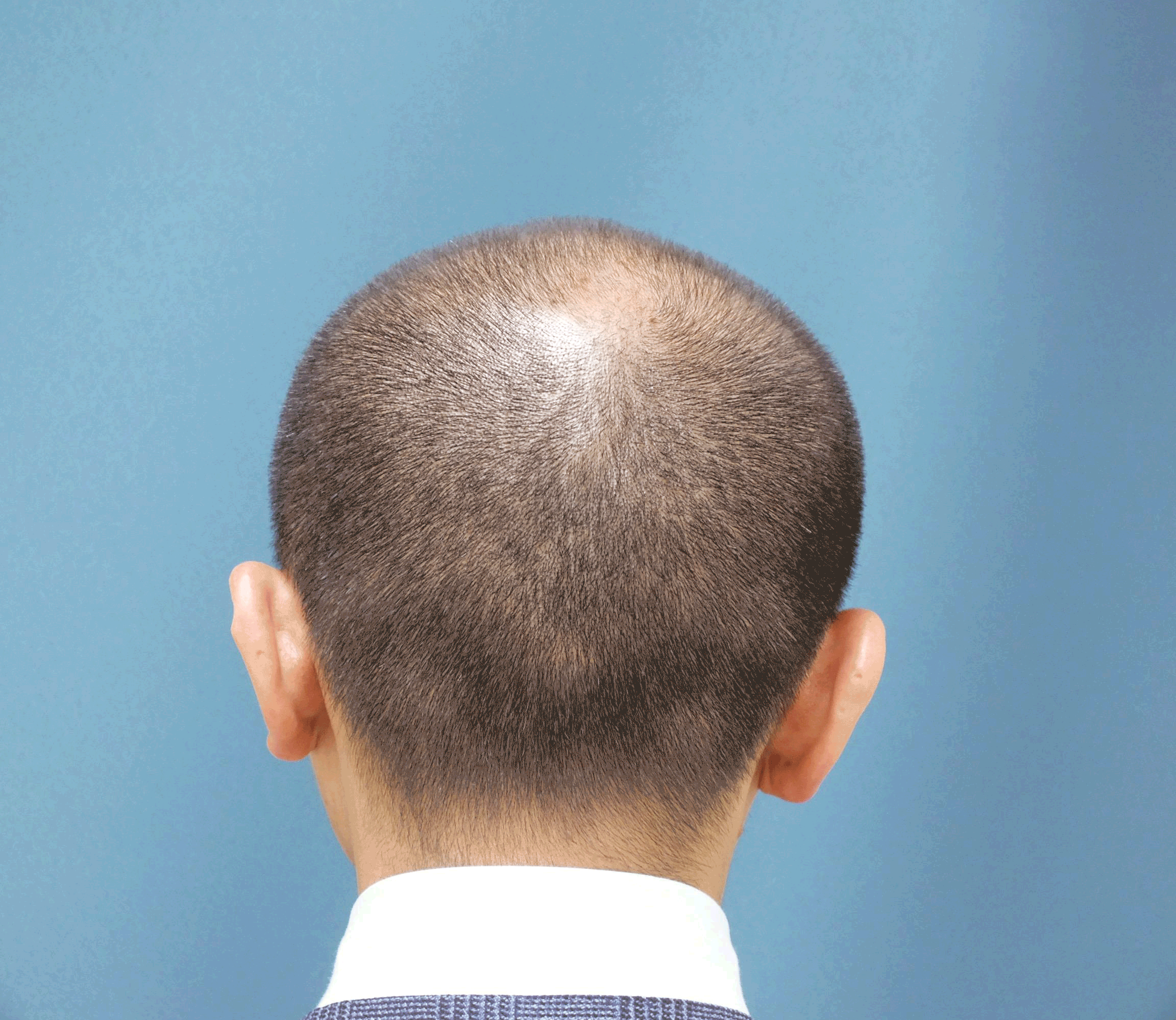 使用前から使用後の頭皮の変化の様子